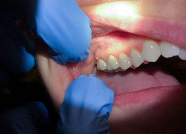 Best Emergency Broken Tooth Repair in Englewood Cliffs, NJ